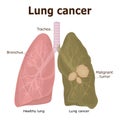 Illustration of lung cancer