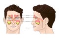 Illustration of man with inflammed paranasal sinuses on white background