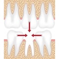 Illustration of missing tooth.