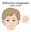 Illustration of Molluscum contagiosum