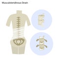 Illustration of Musculotendinous Strain or Lumbar Spine