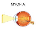 Illustration of myopia. Royalty Free Stock Photo