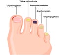 Illustration of nail diseases Royalty Free Stock Photo