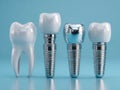 Illustration of natural tooth next to different types of dental implants with various crowns representing modern restorative Royalty Free Stock Photo