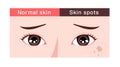 Illustration of normal facial skin and facial skin with spots