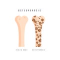 Illustration of osteoporosis bone and healthy bone