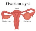 Illustration of Ovarian cyst Royalty Free Stock Photo