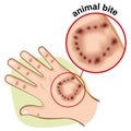 Illustration is part of the human body, hand with an animal bite