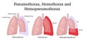 Illustration of Pneumothorax, Hemothorax and Hemopneumothorax