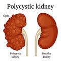 Illustration of polycystic kidney