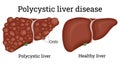 Illustration of polycystic liver disease