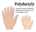 Illustration of Polydactyly Royalty Free Stock Photo