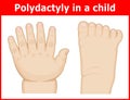 Illustration of Polydactyly in a child