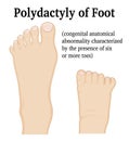 Illustration of Polydactyly of Foot