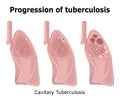 Progression of tuberculosis