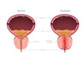 Illustration of Prostatitis Diagram Normal vs Enlarged Prostate Royalty Free Stock Photo