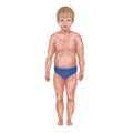 Illustration of the pruritus. Small boy with rashes isolated on white