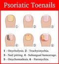 Illustration of Psoriatic toenails Royalty Free Stock Photo