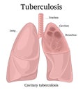 Illustration of pulmonary tuberculosis