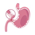 Illustration of Pyloric Stenosis disease