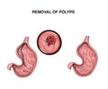 Removal of stomach polyps