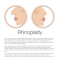 Illustration of rhinoplasty. cosmetic surgery. aesthetic medicine.