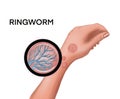 Ringworm on the hand Royalty Free Stock Photo