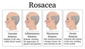 Illustration of Rosacea