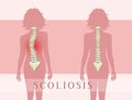 Illustration of scoliosis