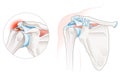 Calcific Tendinitis Shoulder Illustration. Labeled