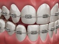 Illustration showing dental braces on straight teeth. 3D illustration