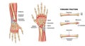 Illustration showing different types of forearm fractures. On the left, an anatomical Royalty Free Stock Photo