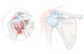Frozen Shoulder Adhesive capsulitis Illustration. Labeled Royalty Free Stock Photo