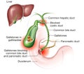 Gallstone disease. gallstones blocking bile duct and pancreatic duct. Labeled Illustration