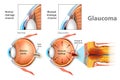 Illustration showing open-angle glaucoma.