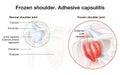 Frozen shoulder. Adhesive capsulitis surgery. Labeled Illustration Royalty Free Stock Photo