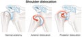 Shoulder dislocation. Anterior dislocation. Posterior dislocation. Labeled Royalty Free Stock Photo