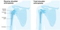 Shoulder arthroplasty. Shoulder replacement. Illustration