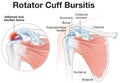 Rotator Cuff Bursitis Shoulder Illustration. Labeled