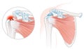 Rotator Cuff Tear Shoulder Illustration Royalty Free Stock Photo