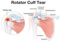 Rotator Cuff Tear Shoulder Illustration. Labeled Royalty Free Stock Photo