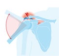 Shoulder joint. Shoulder impingement. Labeled Illustration