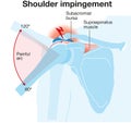 Shoulder joint. Shoulder impingement. Labeled Illustration