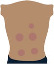 Illustration of Skin markings made by medical Vacuum Cupping therapy on back