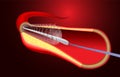 Illustration of stent implantation to support blood flow into the blood vessels Royalty Free Stock Photo