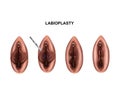 Illustration of the surgery to reduce the labia minora