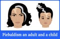 Illustration of Piebaldism in an adult and a child
