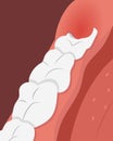 Illustration of teeth row with inflamed gum over the growing wisdom tooth.