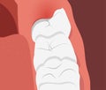 Illustration of teeth row with inflamed gum over the growing wisdom tooth.