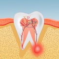 Tooth with abscess